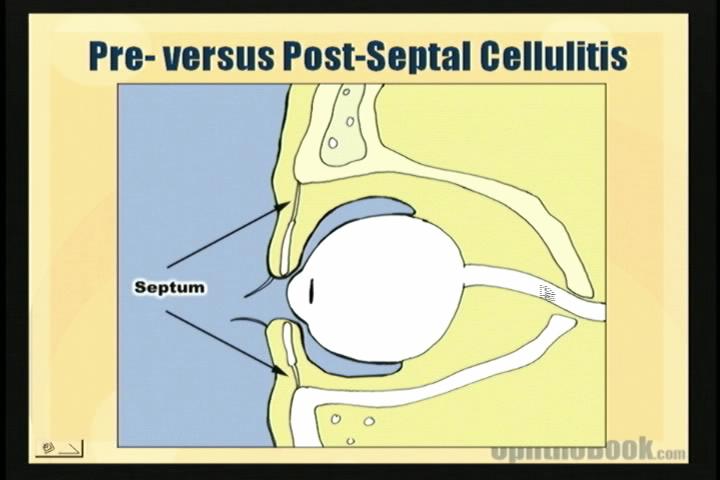 preseptal cellulitis vs orbital cellulitis